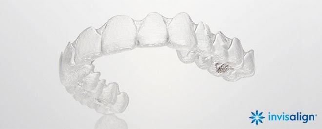 マウスピース矯正(インビザライン)について①〜マウスピース矯正とは〜