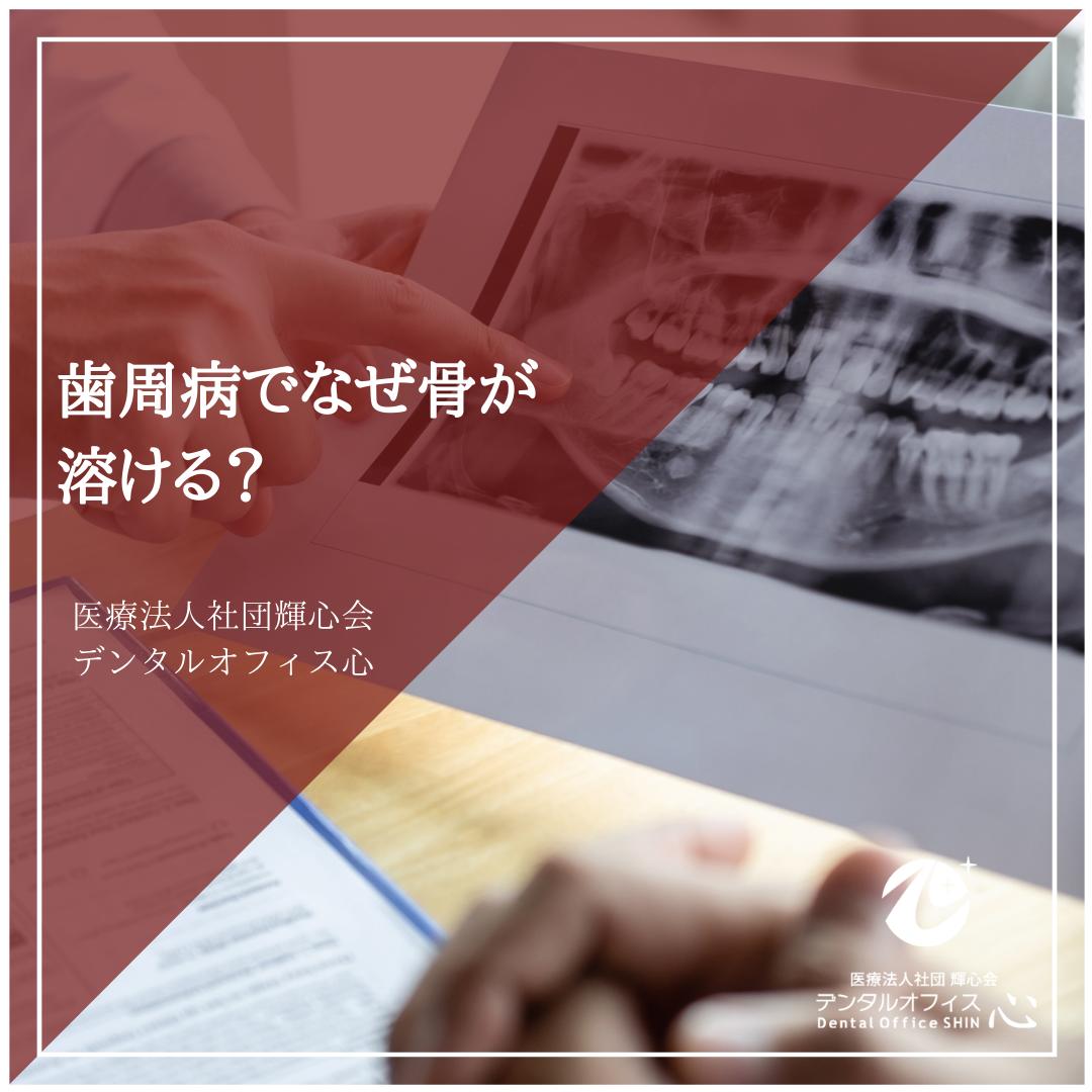 歯周病でなぜ骨が溶ける？