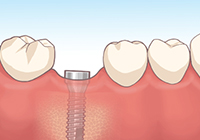 インプラント治療経過 イラスト