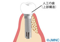 GBR法の流れ step04 イラスト